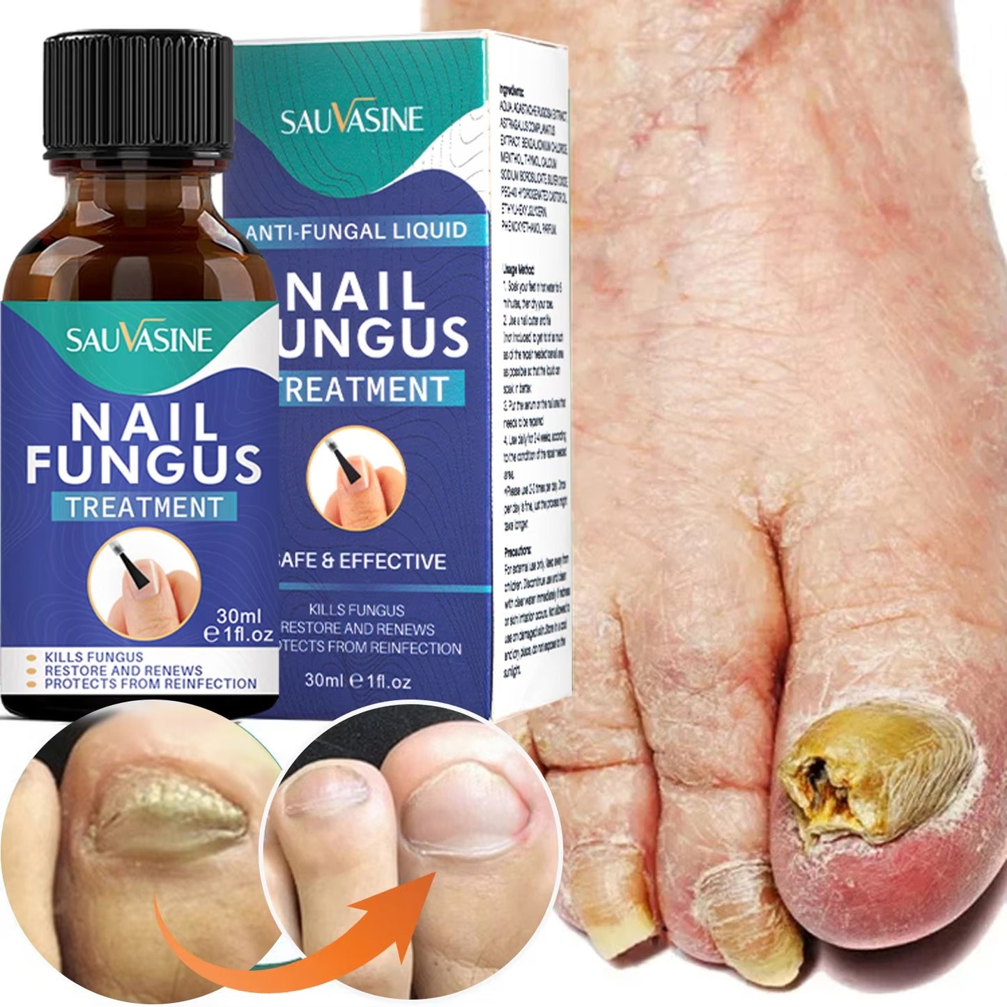 Effective Nail Anti-Fungal Treatment Gel